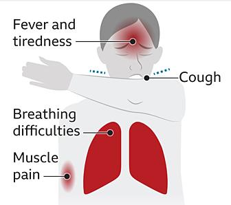 Coronavirus symptoms